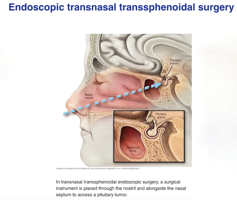 Pituitary Tumor Surgery - Endoscopic transnasal transsphenoidal surgery - Image from https://www.mayoclinic.org/